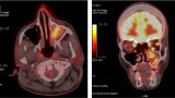 Pacjent, lat 43, ze stwierdzoną podczas operacji przegrody nosa zmianą w zatoce szczękowej lewej (histopatol.: rak płaskonabłonkowy). Fuzja obrazów PET i TK na poziomie zatoki szczękowej.