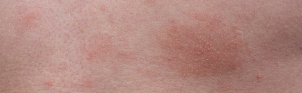 Doniesienia na temat skuteczności dupilumabu w leczeniu atopowego zapalenia skóry