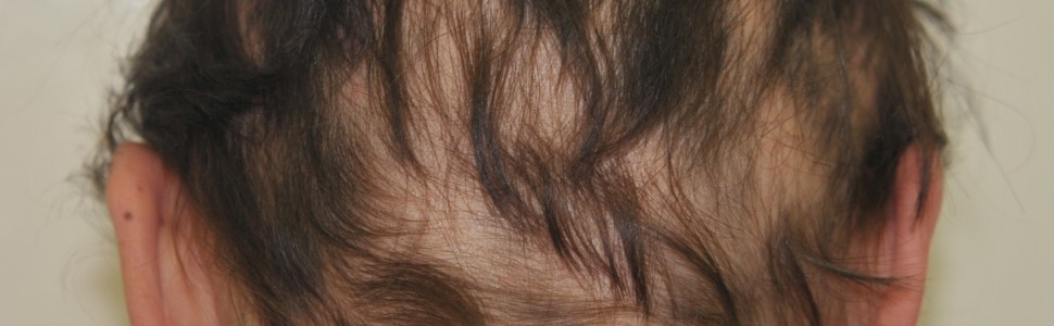 Nowe perspektywy w terapii łysienia plackowatego