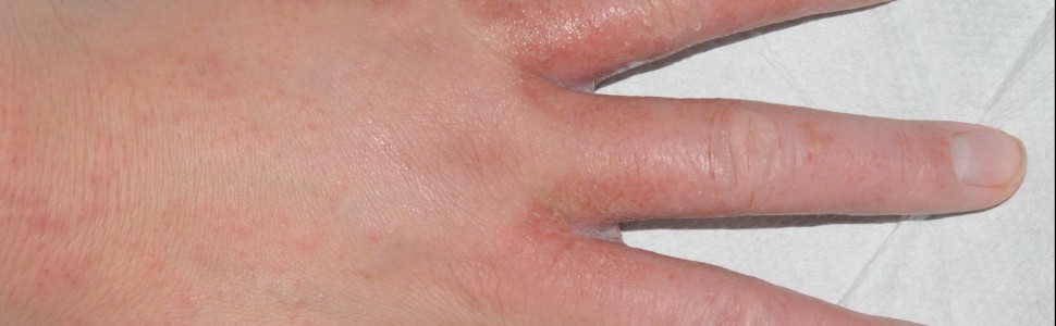Częste mycie rąk znacząco zwiększa ryzyko kontaktowego zapalenia skóry z podrażnienia u pracowników ochrony zdrowia
