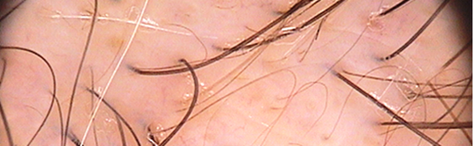 Trichoskopia i inne metody badania włosów