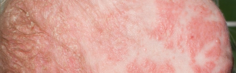 Ryzyko przetrwania objawów atopowego zapalenia skóry w wieku dorosłym