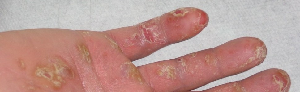 Secukinumab w terapii łuszczycy dłoni i podeszew