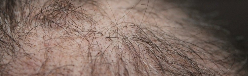 Choroby dermatologiczne towarzyszące łysieniu czołowemu bliznowaciejącemu