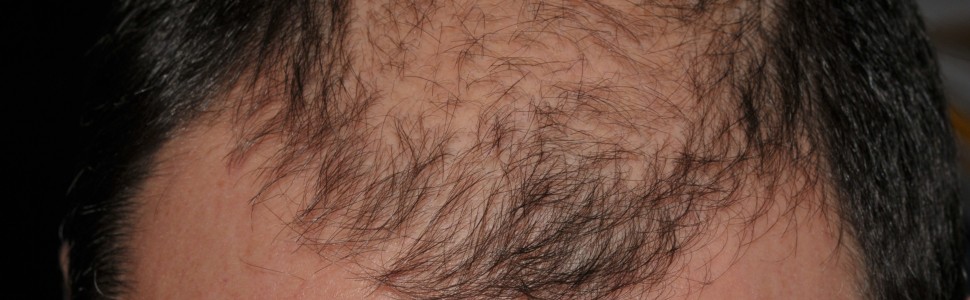 Aplikowany miejscowo 2-proc. tofacytynib skuteczny w leczeniu łysienia plackowatego oraz innych odmian łysienia