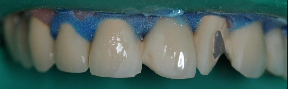 Naprawa mostu porcelanowego na podbudowie metalowej