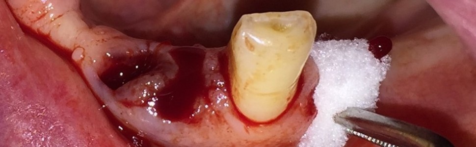 Chirurgia stomatologiczna a leki wpływające na układ krzepnięcia krwi