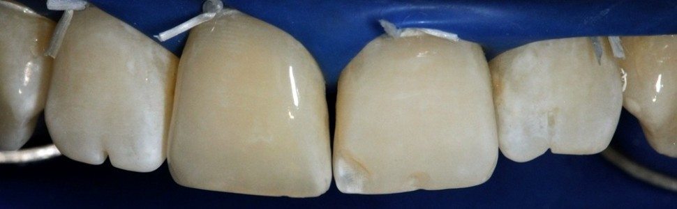 Zmiana kształtu brzegów siecznych z wykorzystaniem materiału kompozytowego 