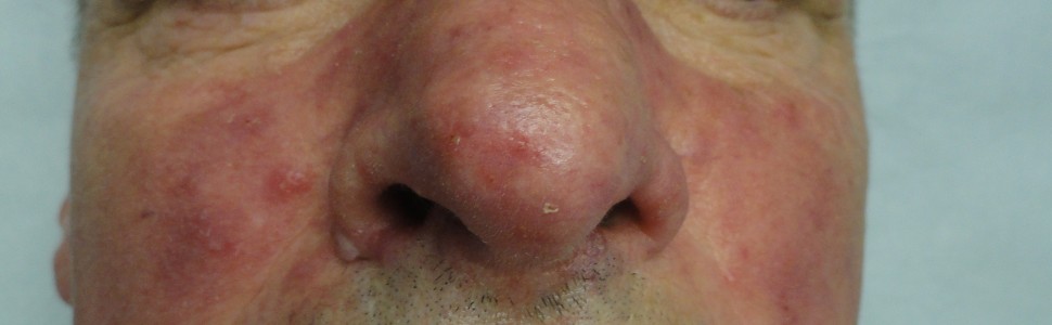Guzowatość nosa (rhinophyma) wykazuje związek ze spożyciem alkoholu