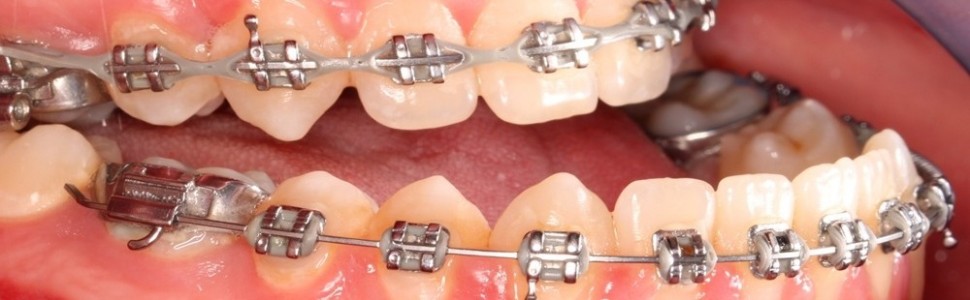 Interdyscyplinarne leczenie wad zgryzu