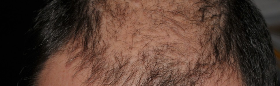 Skuteczność simwastatyny i ezetymibu w leczeniu łysienia plackowatego