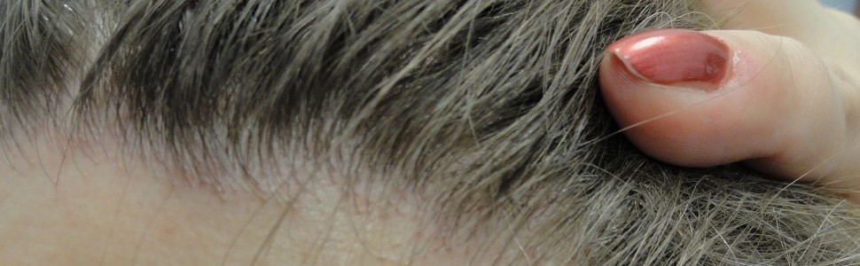 Efekt przeszczepu włosów u pacjentów z łysieniem czołowym bliznowaciejącym