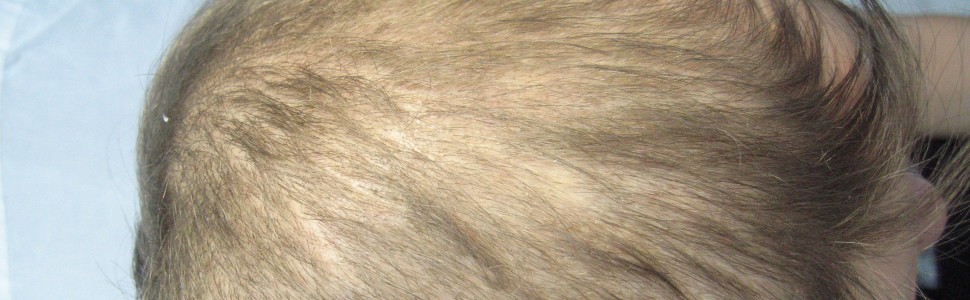 Obraz kliniczny i trichoskopowy łysienia pooperacyjnego