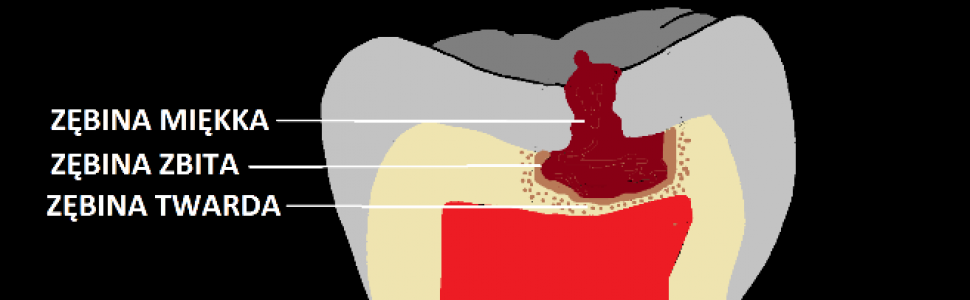 Postępowanie po odsłonięciu miazgi w zębie z niezakończonym rozwojem korzenia