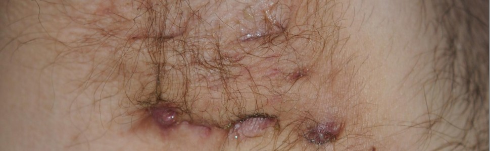 Zwiększone ryzyko występowania łysienia plackowatego u pacjentów z trądzikiem odwróconym