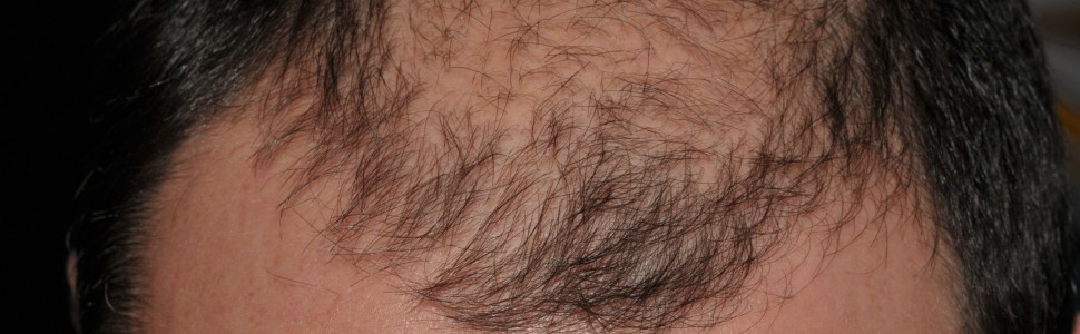 Skuteczność minoksidilu w terapii łysienia androgenowego kobiet