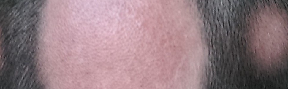 Skuteczność doustnej formy tofacitinibu w leczeniu łysienia plackowatego obejmującego okolicę brody
