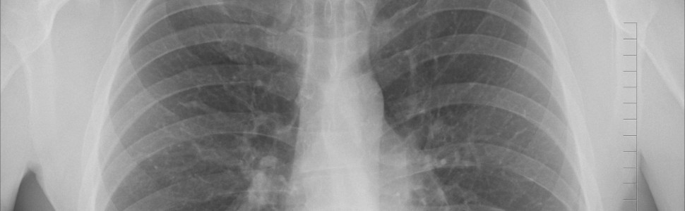 Profilaktyka pneumocystozowego zapalenia płuc z zastosowaniem trimetoprimu i sulfametoksazolu u pacjentów stosujących metotreksat