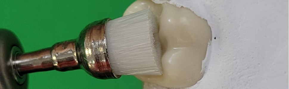 SPECJALISTA RADZI: Odbudowa powierzchni żującej zębów bocznych metodą stempla okluzyjnego