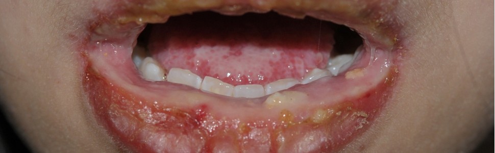 Leczenie biologiczne w pediatrycznym zespole Stevensa-Johnsona/toksycznej nekrolizie naskórka