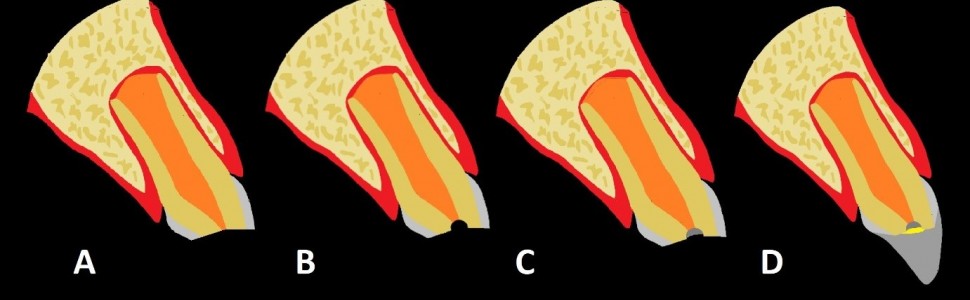 SPECJALISTA RADZI: Powikłane złamanie korony zęba z niezakończonym rozwojem