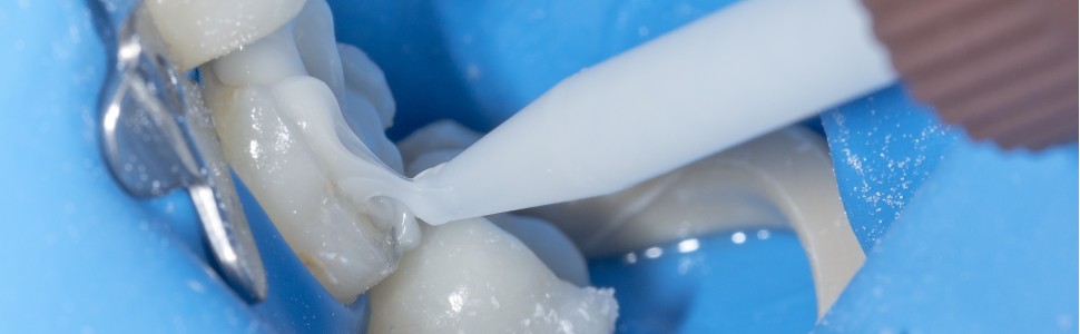 SPECJALISTA RADZI: Cementowanie adhezyjne wkładów i nakładów