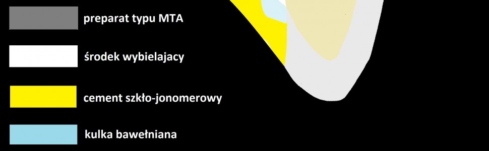 SPECJALISTA RADZI: Przebarwienie korony zęba w następstwie obliteracji systemu kanałowego