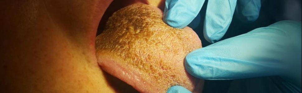 SPECJALISTA RADZI: Język czarny włochaty