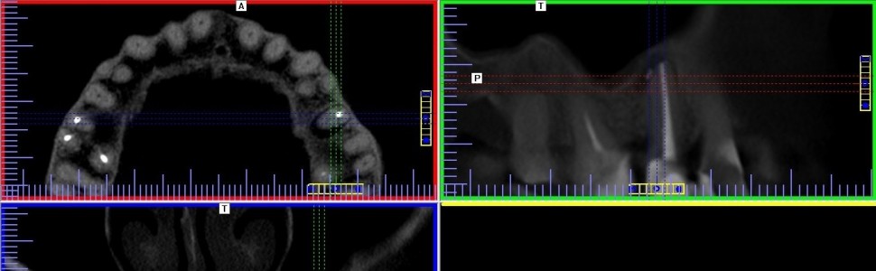 Endodoncja czy implantologia?