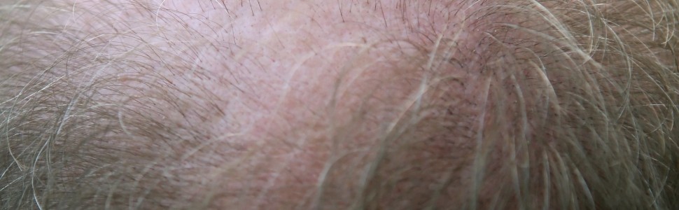 Zastosowanie adalimumabu u pacjentów z wyłysiającym zapaleniem mieszków włosowych