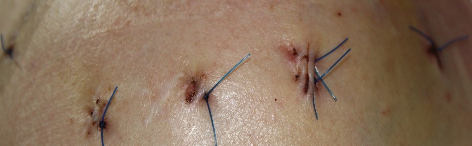 Poprawa gojenia ran chirurgicznych kończyn dolnych po zastosowaniu tymololu w formie miejscowej