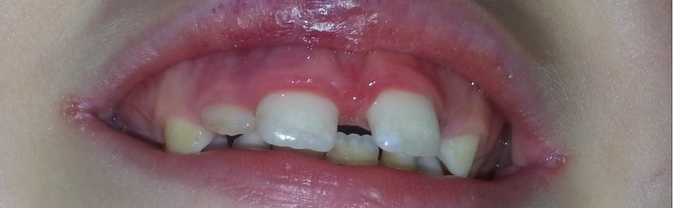 SPECJALISTA RADZI: Zapalenie kątów ust – czy to jedynie lokalny problem?