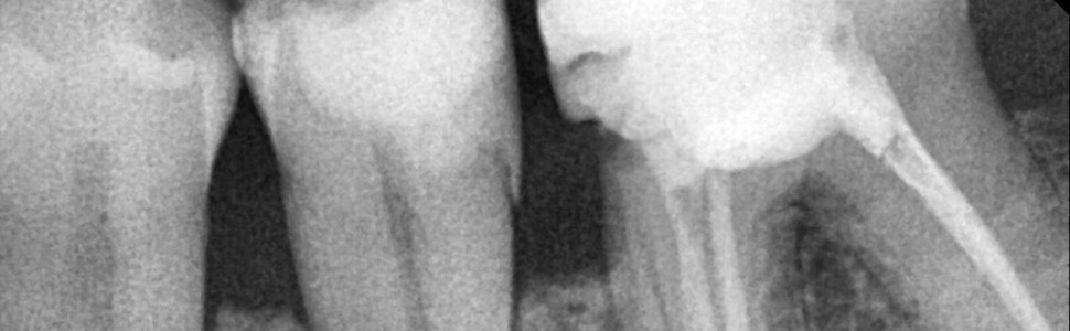 SPECJALISTA RADZI: Niechirurgiczne leczenie periodontologiczne vs leczenie chirurgiczne