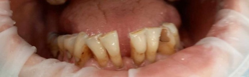 SPECJALISTA RADZI: Unieruchomienie zębów szyną z włókna szklanego w chorobie przyzębia