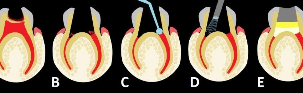 Amputacja miazgi w zębach mlecznych z użyciem siarczanu żelaza