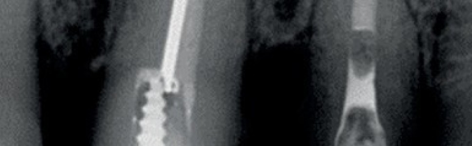 SPECJALISTA RADZI: Nieskuteczna apikotomia wierzchołka  korzenia – ponowna resekcja czy powtórne  leczenie kanałowe? 