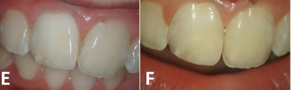 SPECJALISTA RADZI: Wybielanie zębów przebarwionych pastą trójantybiotykową