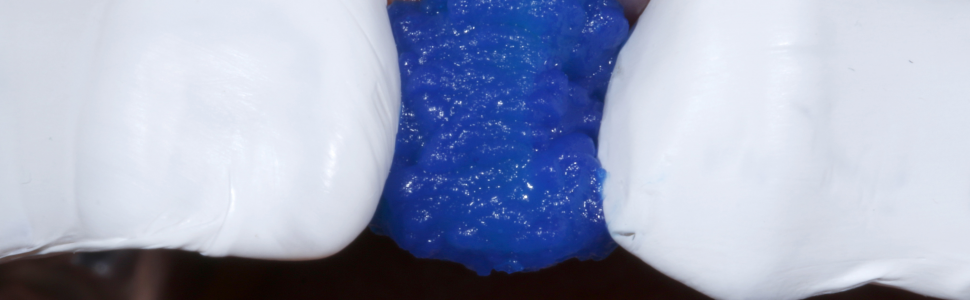 Bezpośrednia licówka kompozytowa w odcinku przednim wykonana z użyciem uniwersalnego kompozytu typu bulk-fill z uproszczonym systemem odcieni  – opis przypadku klinicznego