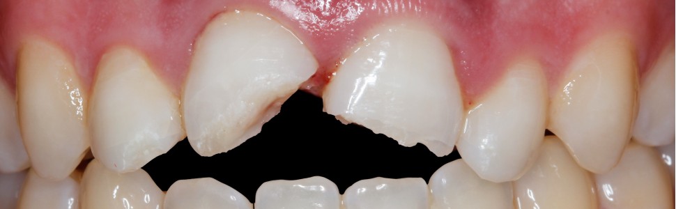 Zastosowanie kompozytów w bezpośredniej odbudowie zębów przednich po urazie