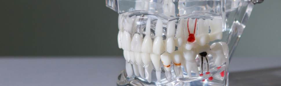 Nietypowa migracja korzenia zęba do komórek sitowych – opisu przypadku i przegląd piśmiennictwa