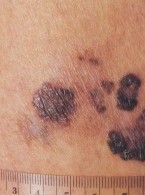Czerniak – najczęściej występujący nowotwór złośliwy skóry