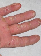 Secukinumab w terapii łuszczycy dłoni i podeszew
