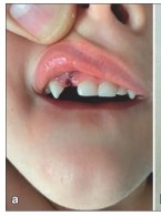 Jak należy postąpić w przypadku wybicia zęba mlecznego?