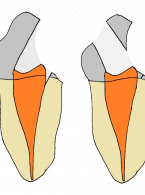 Nietypowa lokalizacja dostępu do jamy zęba