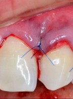 Jak postąpić w przypadku recesji dziąsłowych?