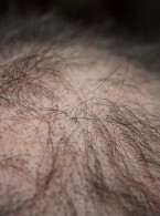 Choroby dermatologiczne towarzyszące łysieniu czołowemu bliznowaciejącemu