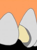 Jak postąpić z uszkodzoną licówką porcelanową?