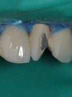 Naprawa mostu porcelanowego na podbudowie metalowej