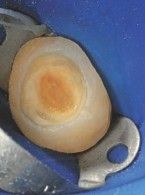 Odbudowa zęba trzonowego metodą półpośrednią