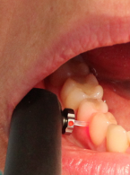 Diagnostyka próchnicy nieubytkowej